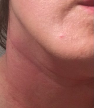 reacción alérgica. (anafilaxia)